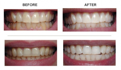 zoom before after